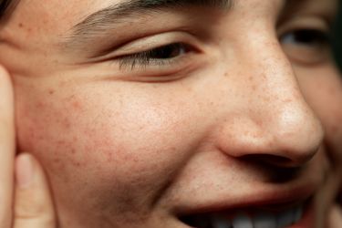 Hyperpigmentation post-inflammatoire (HPPI)  : comprendre, prévenir et traiter les taches pigmentaires après un soin esthétique - Dr Meulebrouck - Cabinet de médecine esthétique du grand Amiens