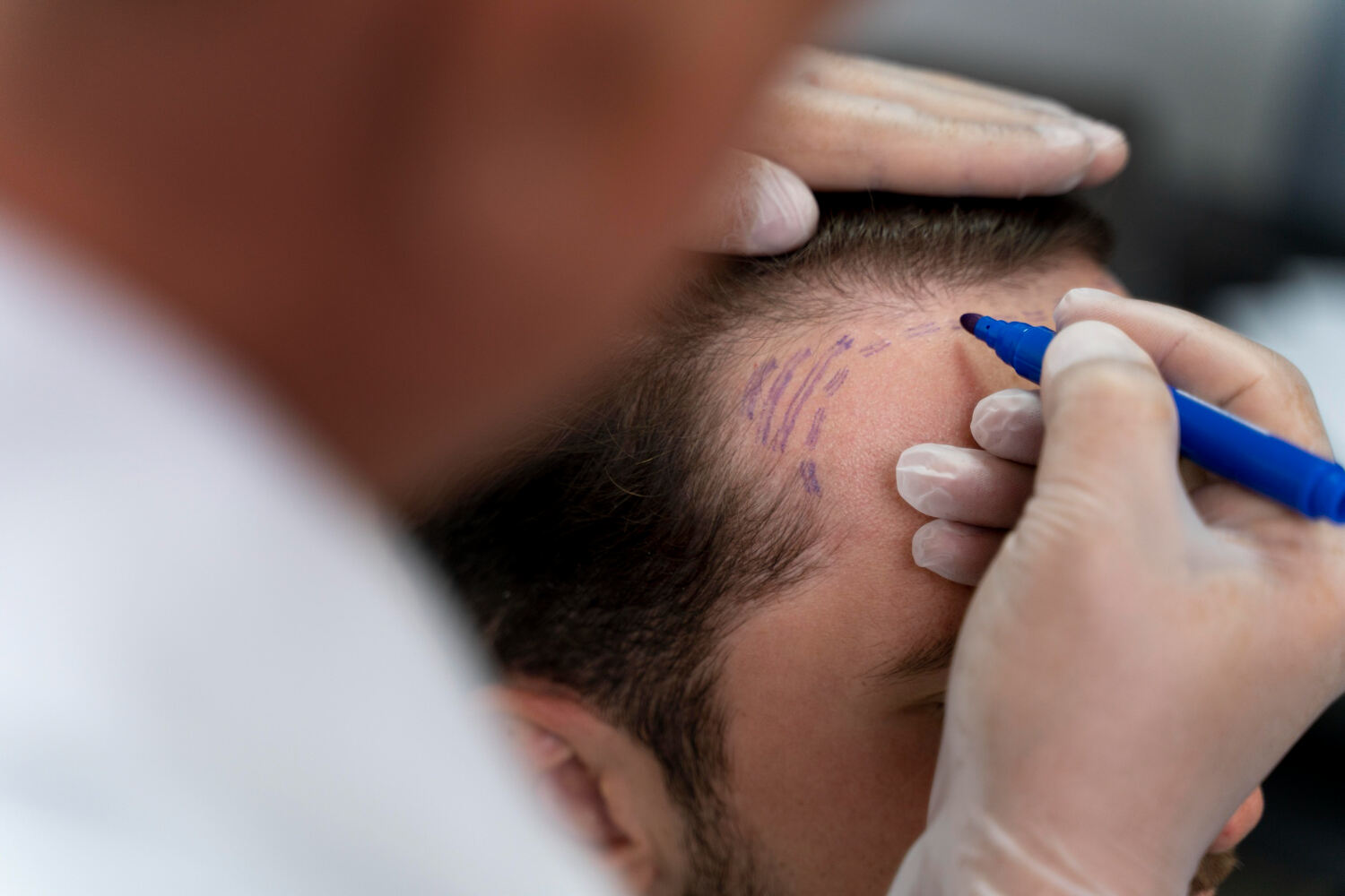 Une greffe capillaire est-elle douloureuse ? - Dr Meulebrouck - Cabinet de médecine esthétique du grand Amiens