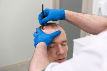 Importance de la ligne frontale dans une greffe capillaire - Dr Meulebrouck - Cabinet de médecine esthétique du grand Amiens