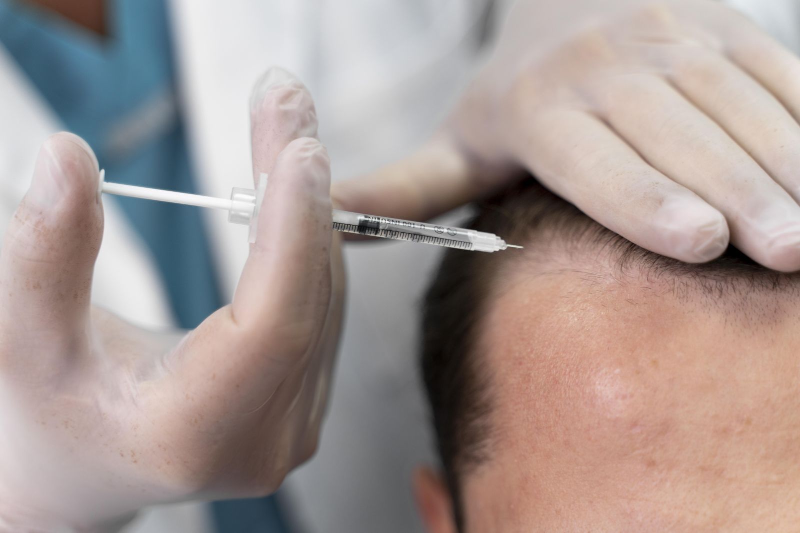 PRP cheveux - Docteur Maxime Meulebrouck, Cabinet de médecine esthétique du grand Amiens