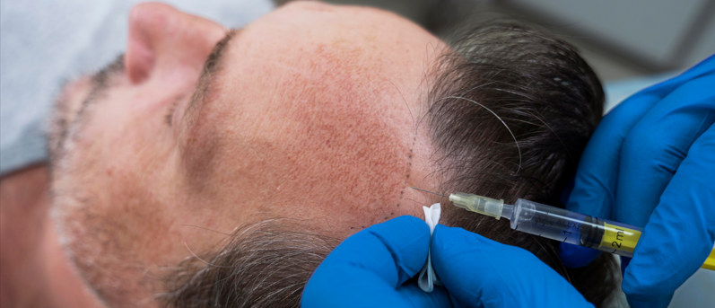 Anesthésie en greffe capillaire : confort et sécurité - Dr Meulebrouck Cabinet esthétique Amiens