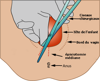 Traitement des cicatrices d'épisiotomie par acide hyaluronique : restaurer le confort et la qualité des tissus - Dr Meulebrouck Cabinet esthétique Amiens