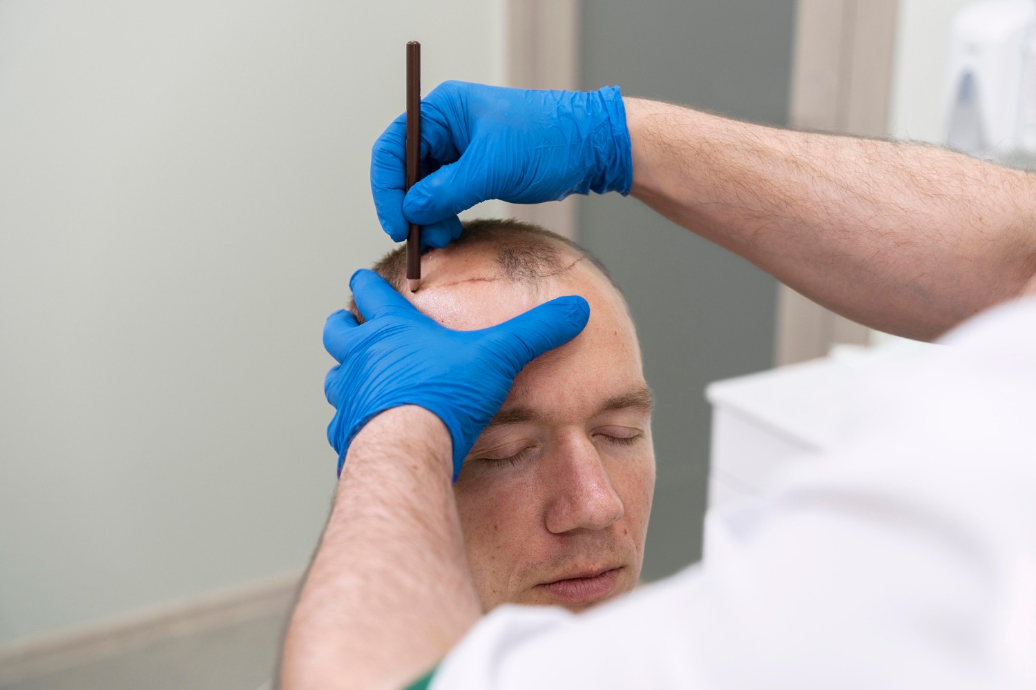 Importance de la ligne frontale dans une greffe capillaire - Dr Meulebrouck Cabinet de médecine esthétique Amiens